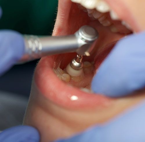 Zahnreinigung Zahnarztpraxis Dr. Hartmann – Dr